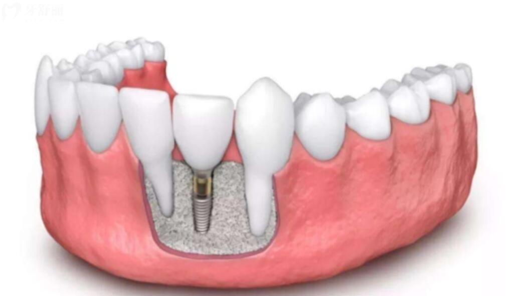 种植牙和镶牙哪个好 种植牙和镶牙哪个好