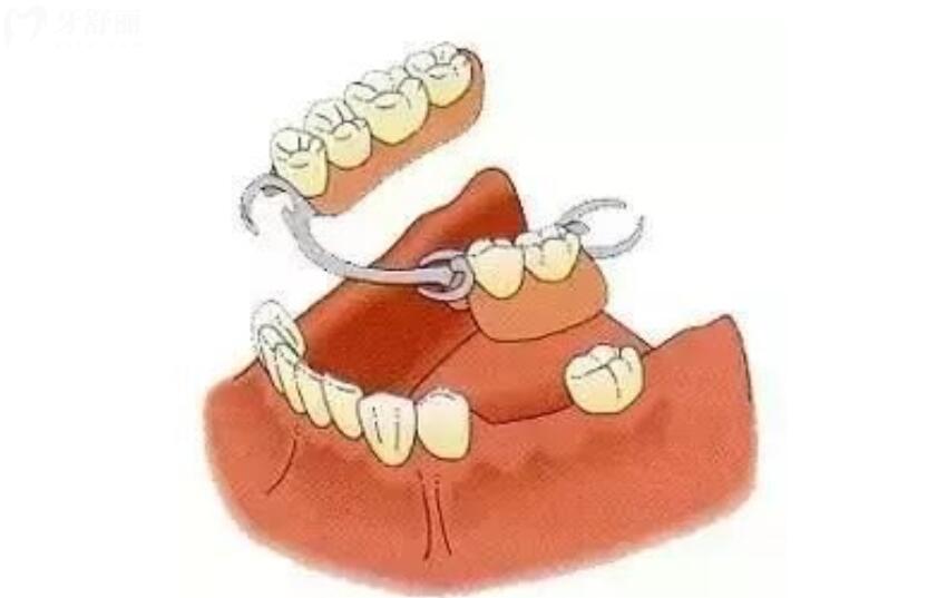 种植牙和镶牙哪个好 种植牙和镶牙哪个好