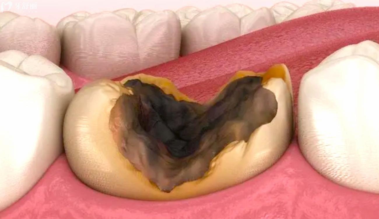 大牙烂了只剩一点空壳了怎么办.jpg 大牙烂了只剩一点空壳了怎么办.jpg