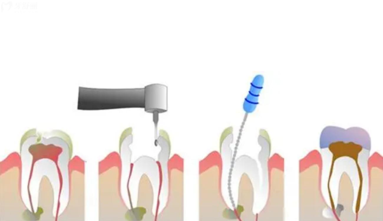 大牙烂了只剩一点空壳了怎么办.jpg 大牙烂了只剩一点空壳了怎么办.jpg