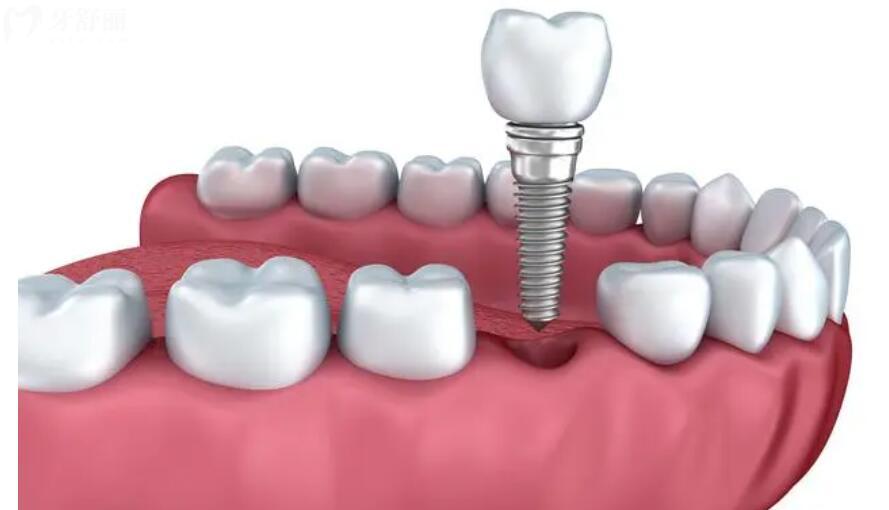 美国种植牙品牌及收费价格表 美国种植牙品牌及收费价格表