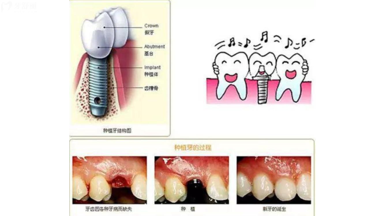 种植牙.jpg 种植牙.jpg