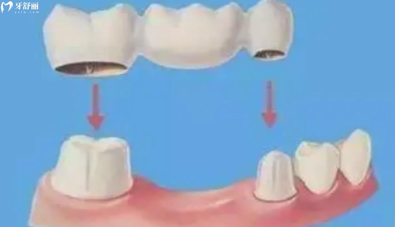 镶牙.jpg 镶牙.jpg