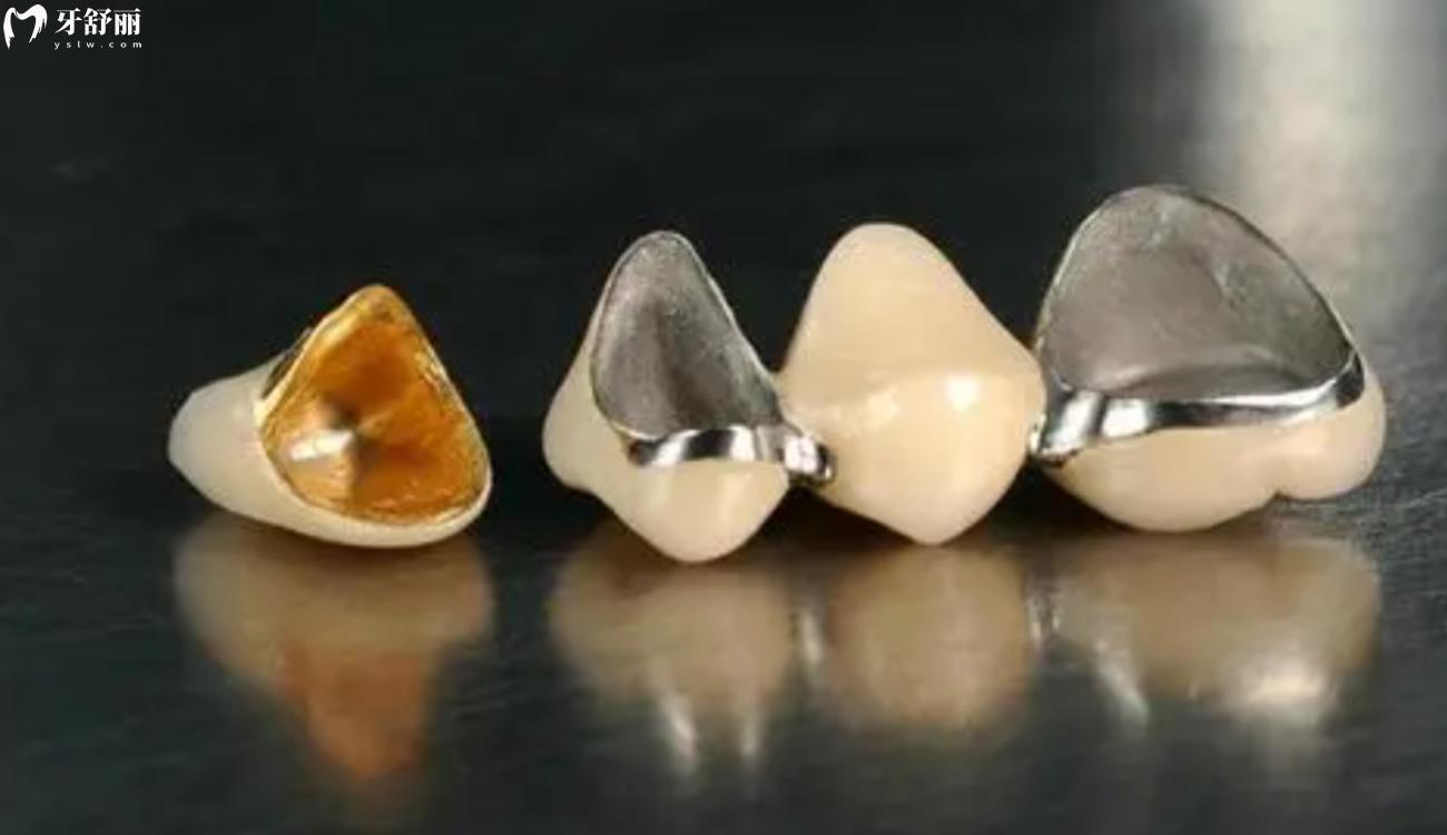 烤瓷牙.jpg 烤瓷牙.jpg