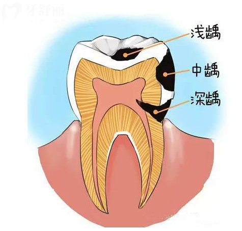 一颗健康的牙齿是怎么发展成为一颗烂牙的?其实只有简单几步 一颗健康的牙齿是怎么发展成为一颗烂牙的?其实只有简单几步