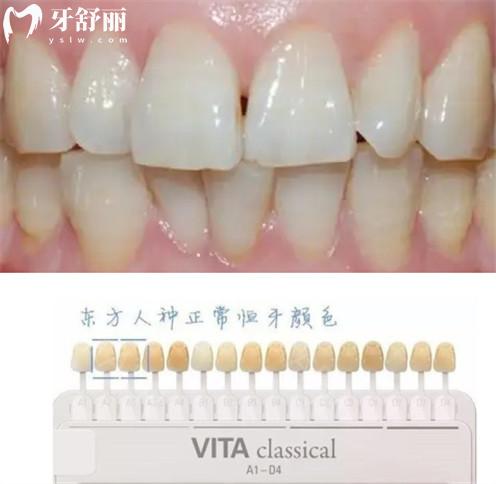 网上的美牙仪可以使用吗?小心造成不可逆的损伤 网上的美牙仪可以使用吗?小心造成不可逆的损伤