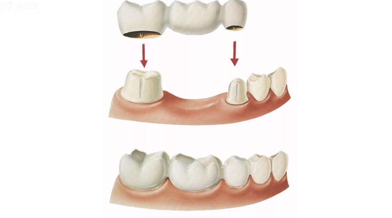 牙齿搭桥怎么收费?牙齿搭桥的类型寿命是什么? 牙齿搭桥怎么收费?牙齿搭桥的类型寿命是什么?