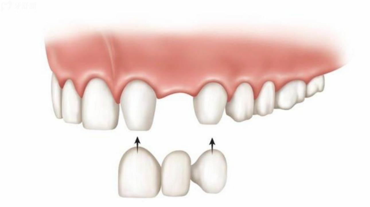 牙齿搭桥怎么收费?牙齿搭桥的类型寿命是什么? 牙齿搭桥怎么收费?牙齿搭桥的类型寿命是什么?
