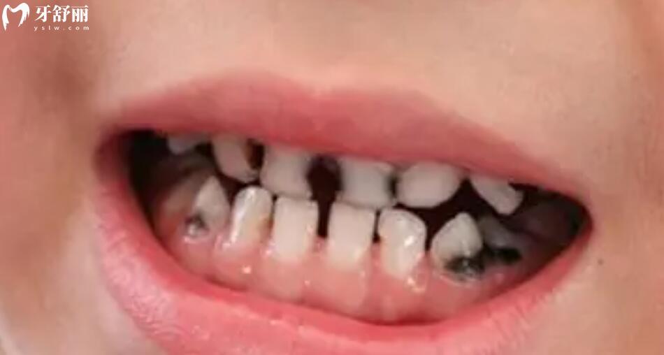 幼儿应该如何保护牙齿 幼儿应该如何保护牙齿