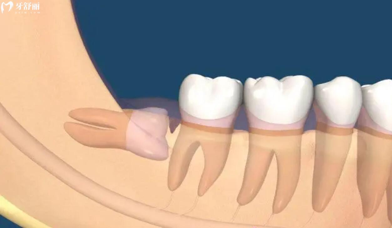 拔智齿期要多久再拔另一侧牙齿好?智齿拔出后需要注意什么 拔智齿期要多久再拔另一侧牙齿好?智齿拔出后需要注意什么