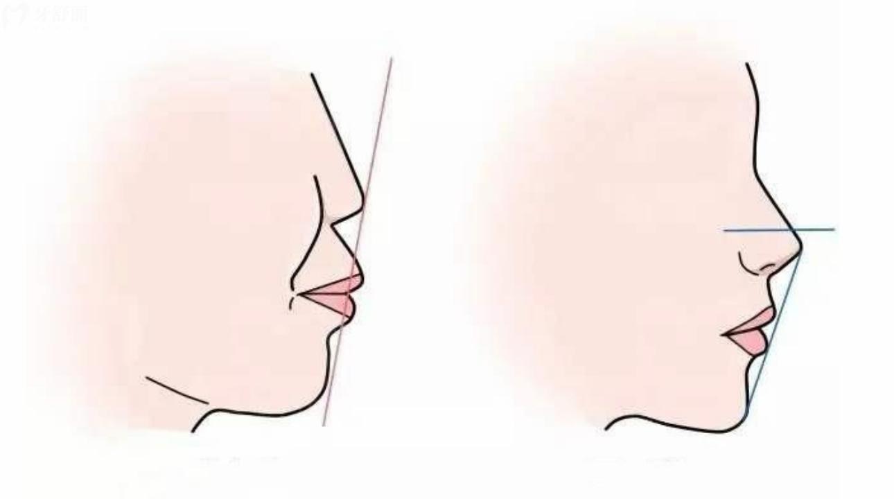 听说凸嘴千万不要戴牙套矫正?会越带越凸这是真的吗? 听说凸嘴千万不要戴牙套矫正?会越带越凸这是真的吗?