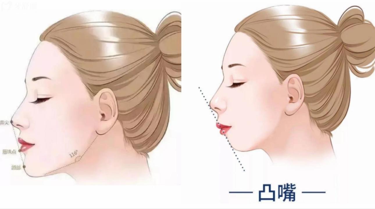 听说凸嘴千万不要戴牙套矫正?会越带越凸这是真的吗? 听说凸嘴千万不要戴牙套矫正?会越带越凸这是真的吗?