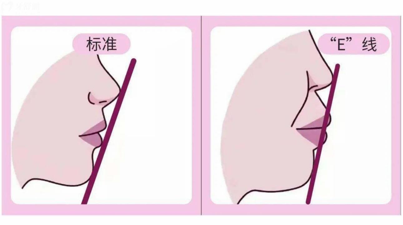 听说凸嘴千万不要戴牙套矫正?会越带越凸这是真的吗? 听说凸嘴千万不要戴牙套矫正?会越带越凸这是真的吗?