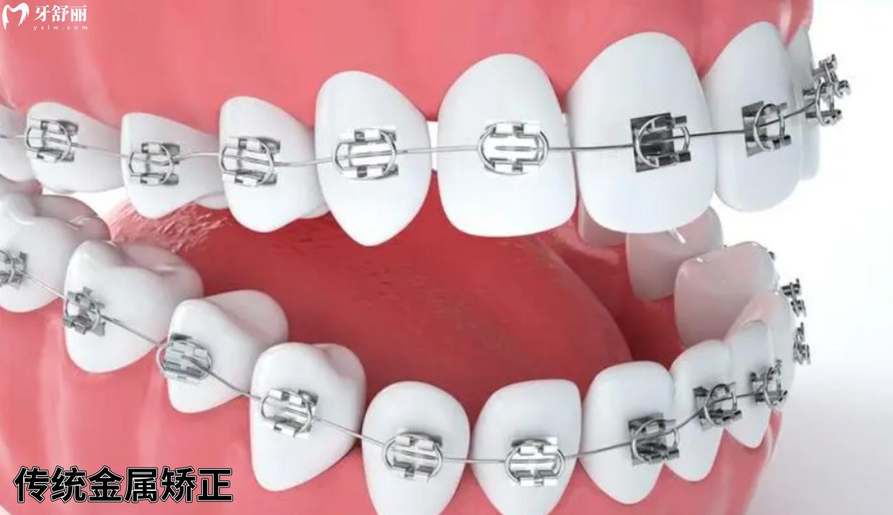 自己网上买的牙套矫正成功了是真的吗.jpg 自己网上买的牙套矫正成功了是真的吗.jpg