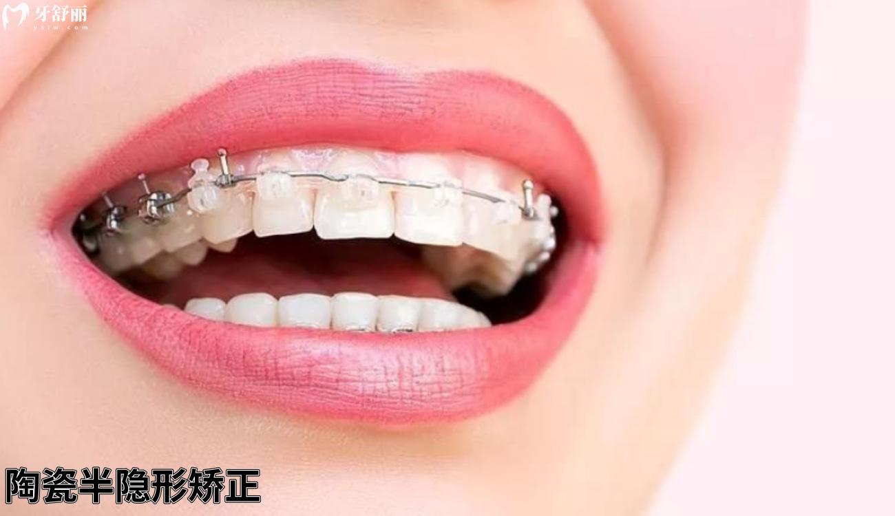 自己网上买的牙套矫正成功了是真的吗.jpg 自己网上买的牙套矫正成功了是真的吗.jpg