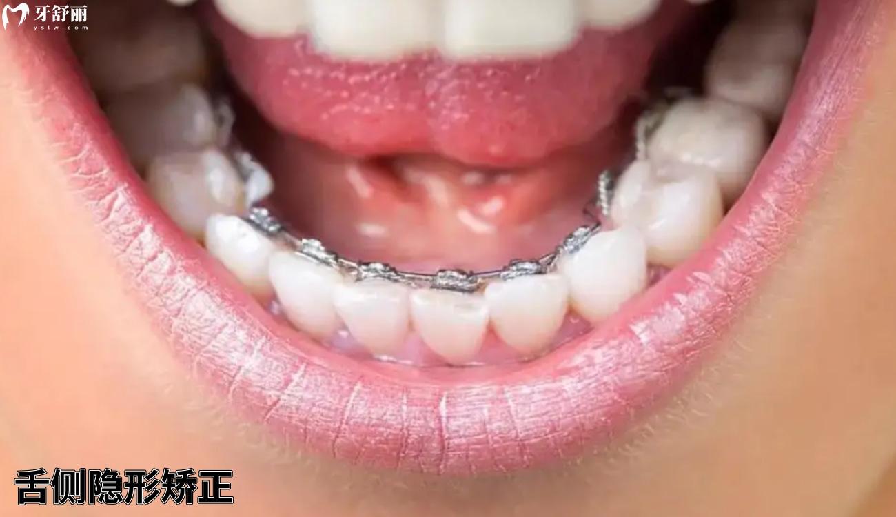 自己网上买的牙套矫正成功了是真的吗.jpg 自己网上买的牙套矫正成功了是真的吗.jpg