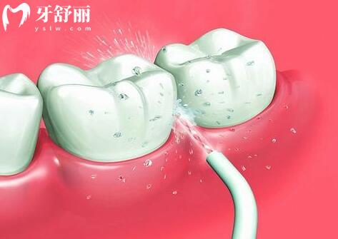 为什么洗牙会难受，洗牙的完整过程是怎么样的？