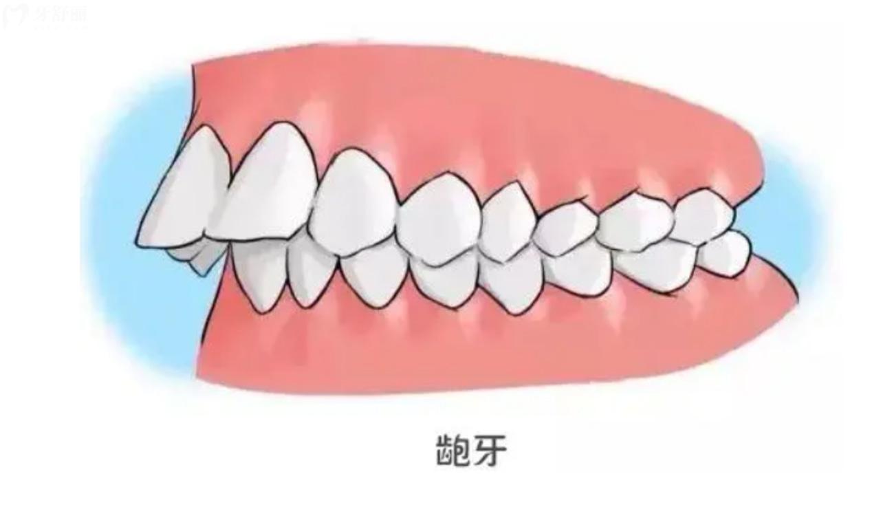 怎么看自己是不是龅牙.jpg 怎么看自己是不是龅牙.jpg