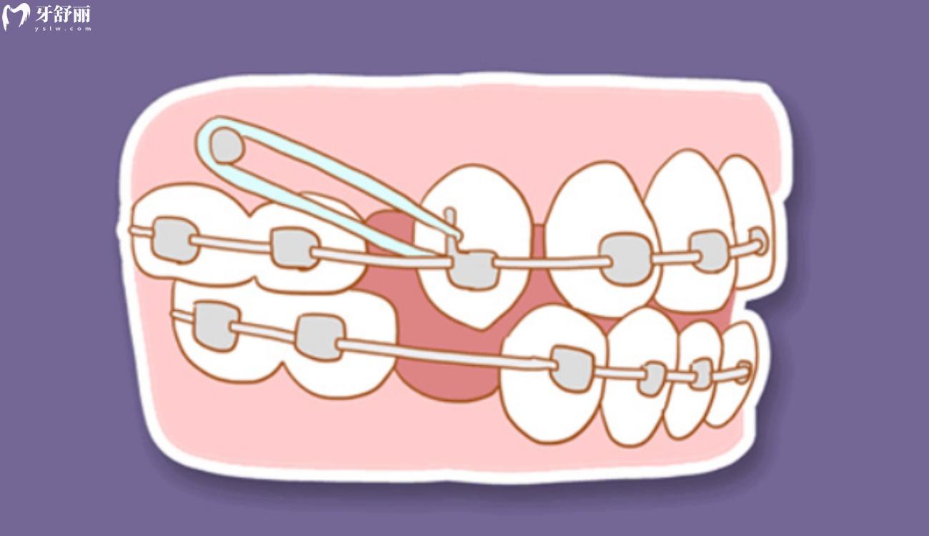 怎么看自己是不是龅牙.jpg 怎么看自己是不是龅牙.jpg