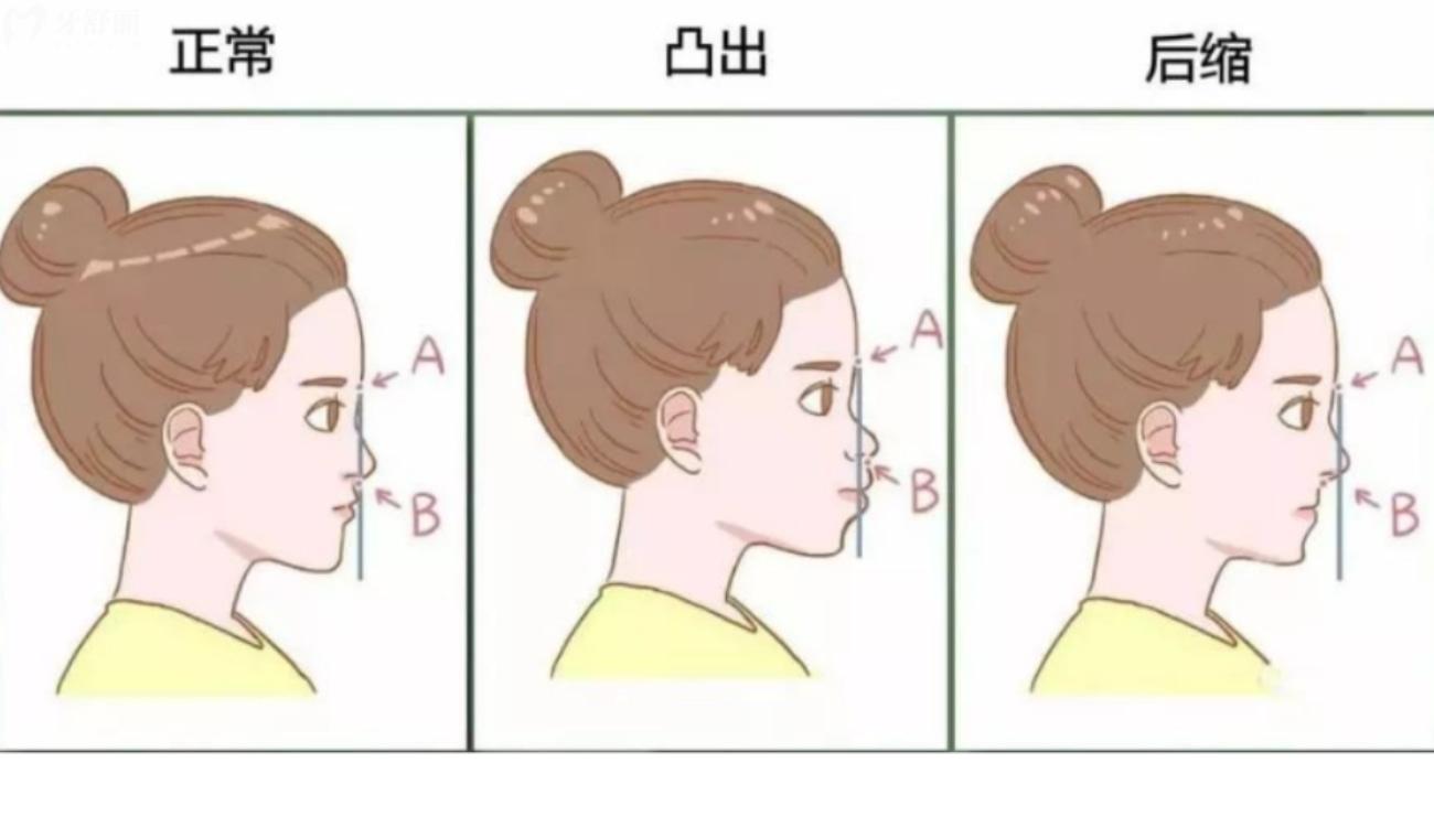 怎么看自己是不是龅牙.jpg 怎么看自己是不是龅牙.jpg