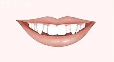 可爱“小虎牙”需不需要拔?如何干预孩子虎牙不突出 可爱“小虎牙”需不需要拔?如何干预孩子虎牙不突出