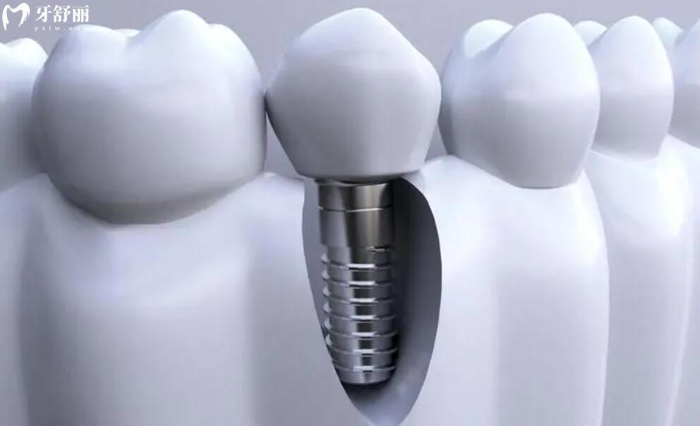 种植牙的**高吗 种植牙的**高吗