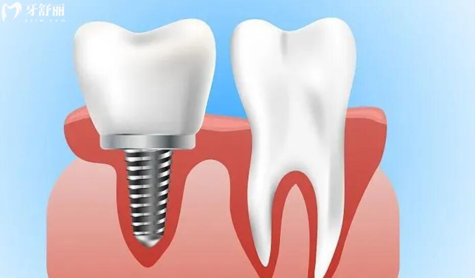 种植牙的**高吗 种植牙的**高吗