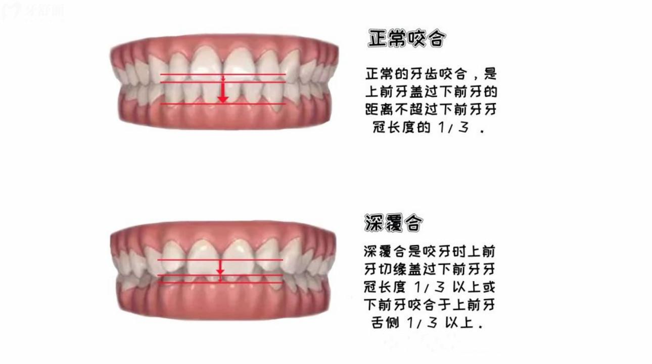 成人牙齿深覆合深覆盖怎么办 什么是深覆合深覆盖? 成人牙齿深覆合深覆盖怎么办 什么是深覆合深覆盖?