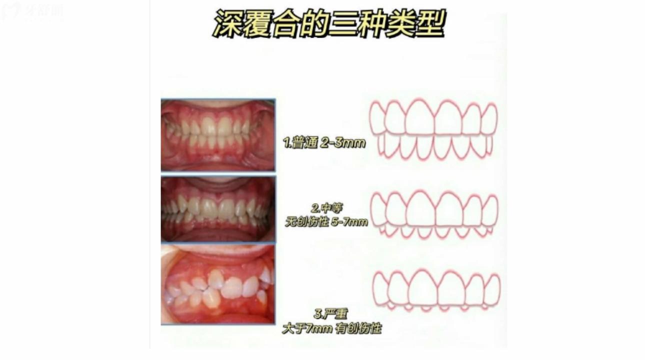 成人牙齿深覆合深覆盖怎么办 什么是深覆合深覆盖? 成人牙齿深覆合深覆盖怎么办 什么是深覆合深覆盖?