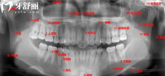 牙科拍的牙片怎么看?叫你简单几步看牙片不被坑 牙科拍的牙片怎么看?叫你简单几步看牙片不被坑