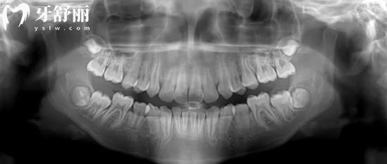 牙科拍的牙片怎么看?叫你简单几步看牙片不被坑 牙科拍的牙片怎么看?叫你简单几步看牙片不被坑