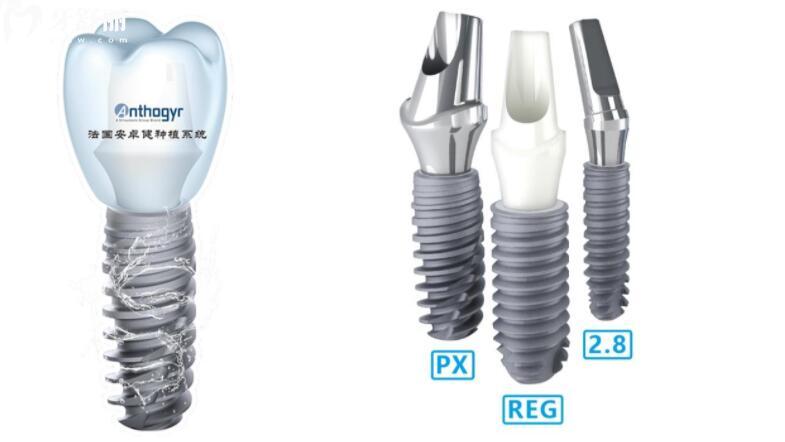法国安卓健种植牙是什么档次 法国安卓健种植牙是什么档次