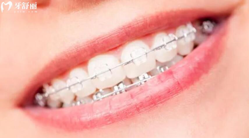 牙齿拥挤怎么办 牙齿拥挤怎么办