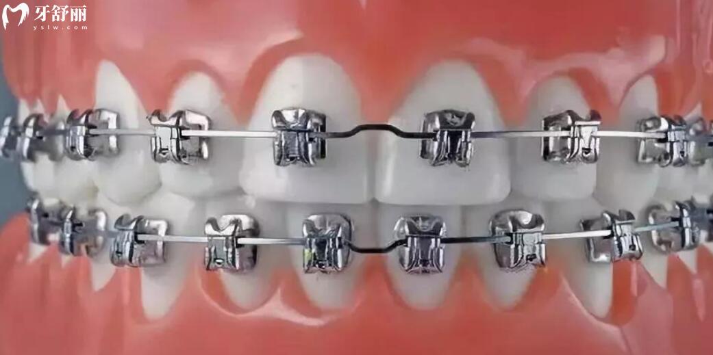牙齿拥挤怎么办 牙齿拥挤怎么办