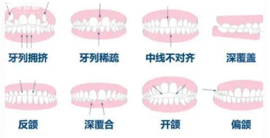 牙齿拥挤怎么办 牙齿拥挤怎么办
