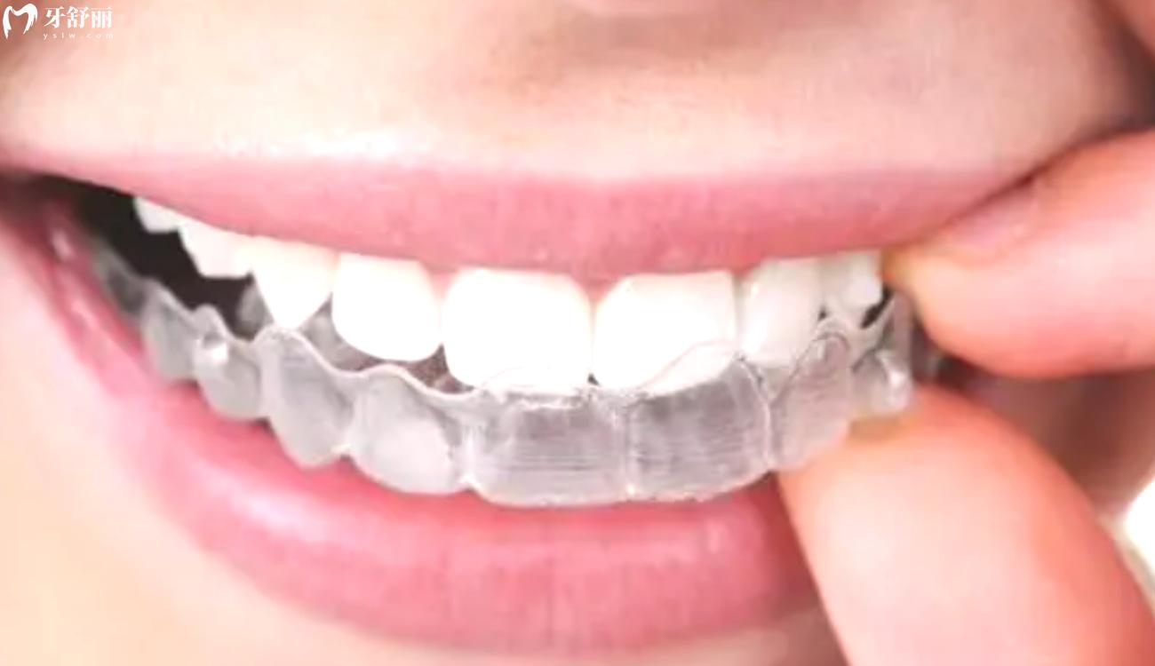 正畸牙齿后遗症太可怕了.jpg 正畸牙齿后遗症太可怕了.jpg