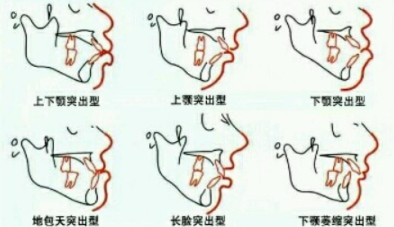 怎么看婴儿是否龅牙.jpg 怎么看婴儿是否龅牙.jpg