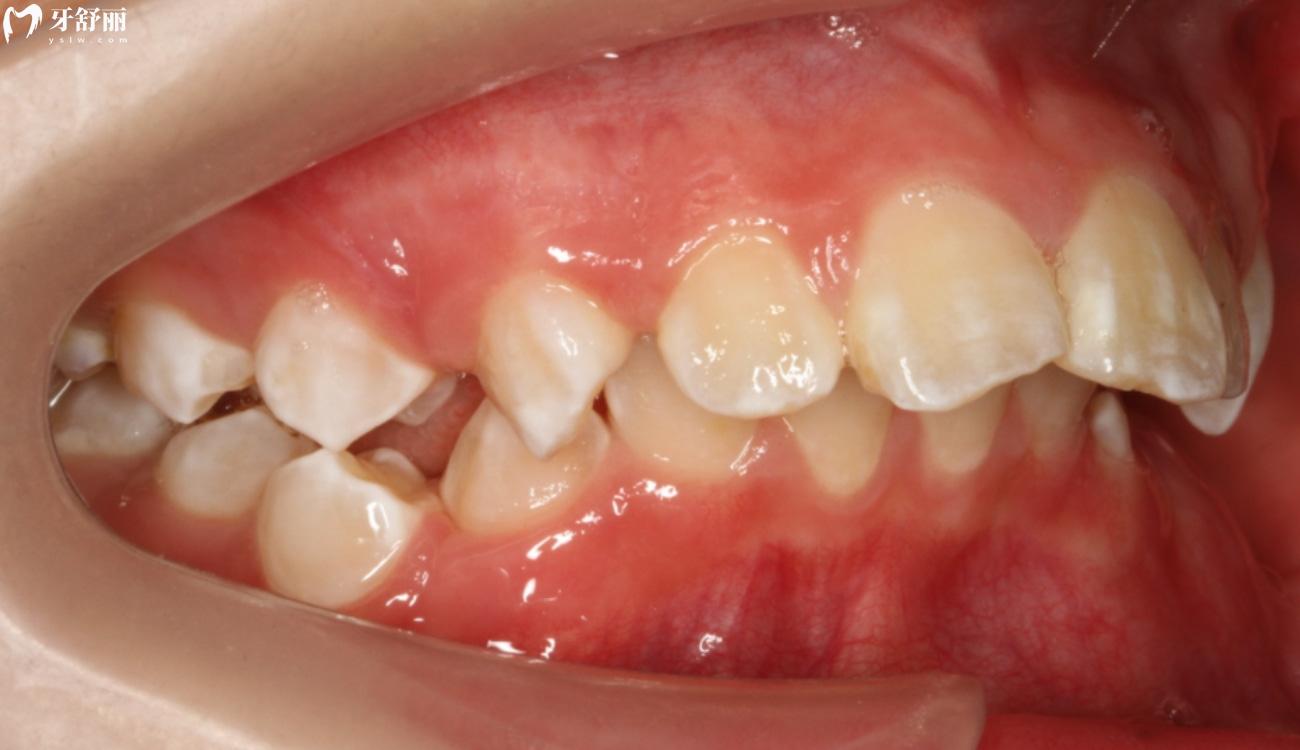 怎么看婴儿是否龅牙.jpg 怎么看婴儿是否龅牙.jpg