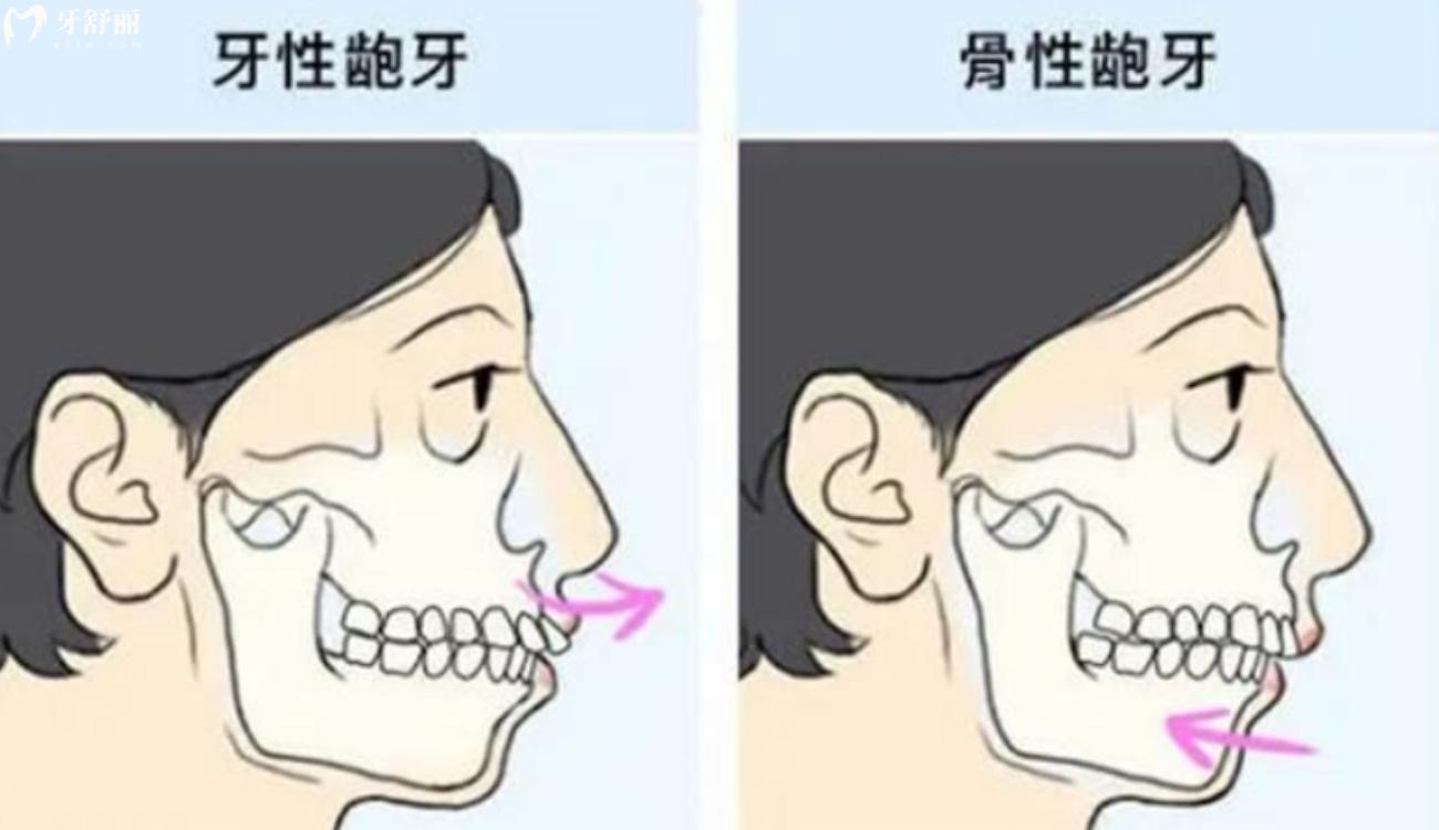 怎么看婴儿是否龅牙.jpg 怎么看婴儿是否龅牙.jpg