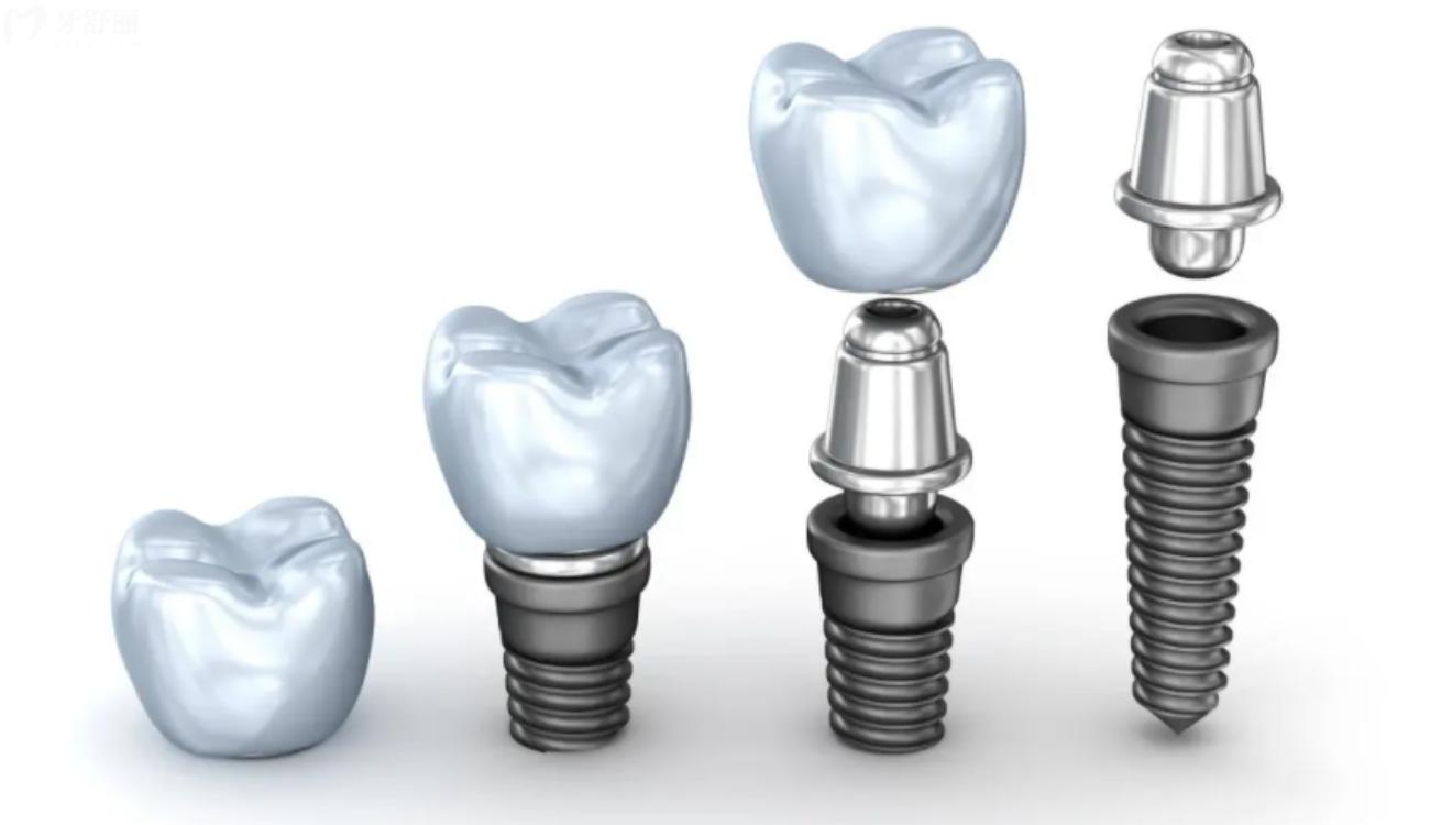 茂名种植牙多少钱一个.jpg 茂名种植牙多少钱一个.jpg