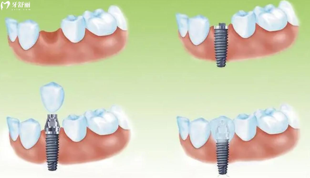 茂名种植牙多少钱一个.jpg 茂名种植牙多少钱一个.jpg