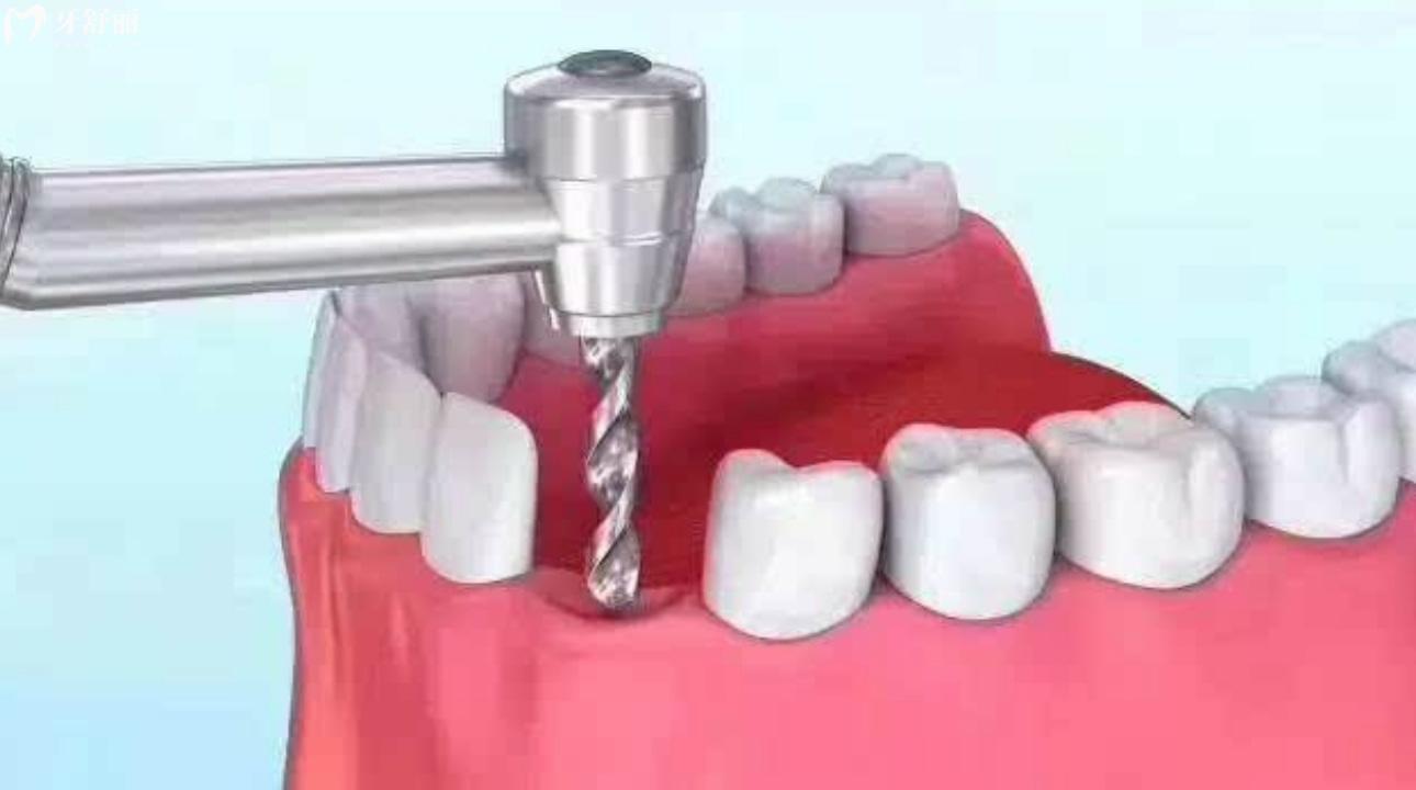 种植牙手术后可以跑步锻炼身体吗?种植牙后脸肿了怎么办? 种植牙手术后可以跑步锻炼身体吗?种植牙后脸肿了怎么办?