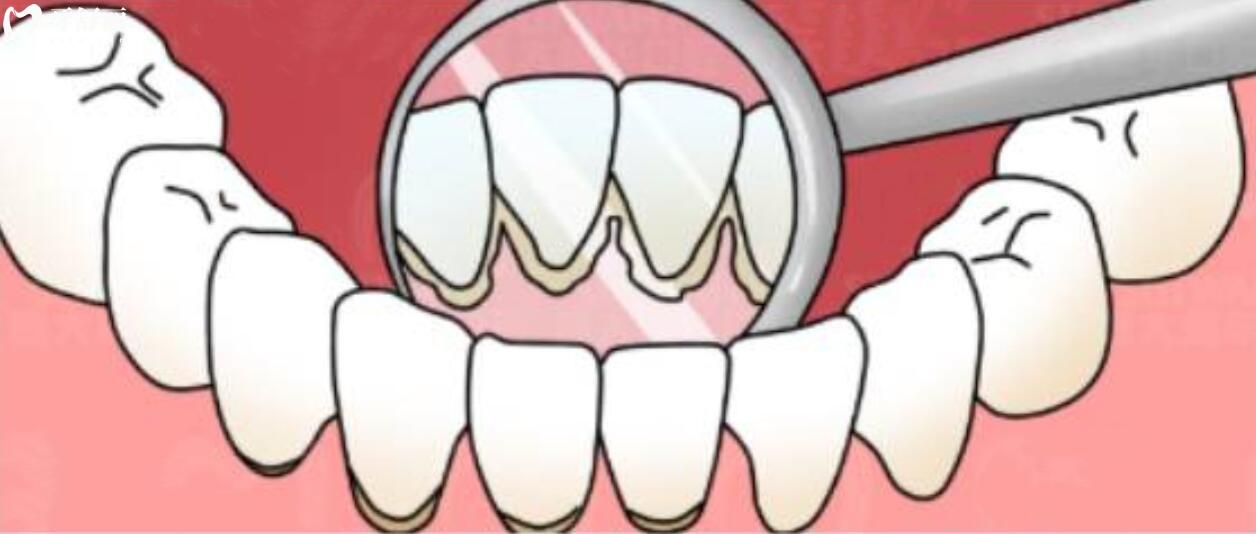 牙龈有点发黑也不疼是怎么回事?应该怎么解决呢 牙龈有点发黑也不疼是怎么回事?应该怎么解决呢