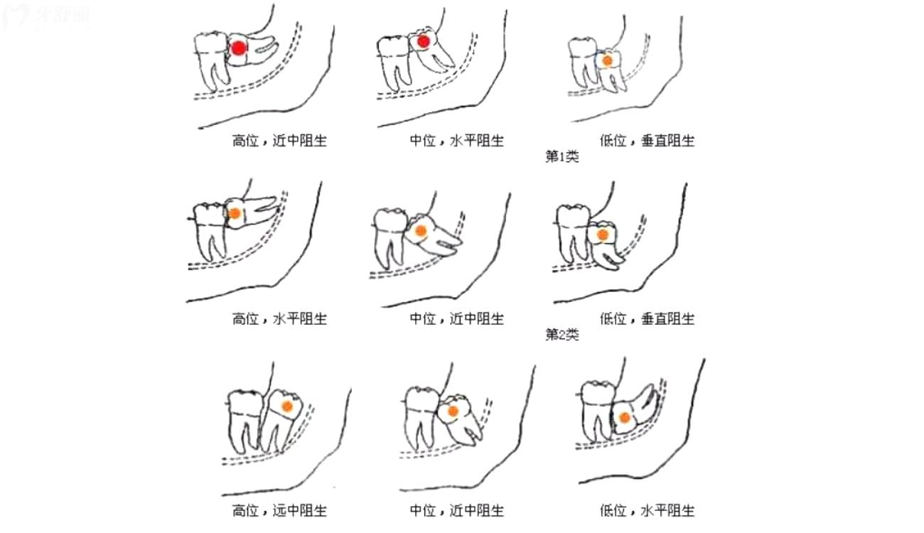 必须拔掉的智齿.jpg