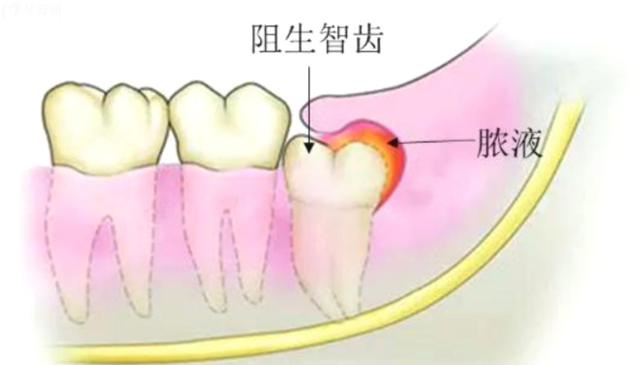 必须拔掉的智齿.jpg 必须拔掉的智齿.jpg