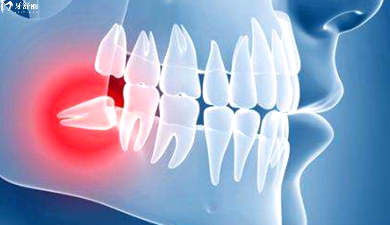 必须拔掉的智齿.jpg 必须拔掉的智齿.jpg
