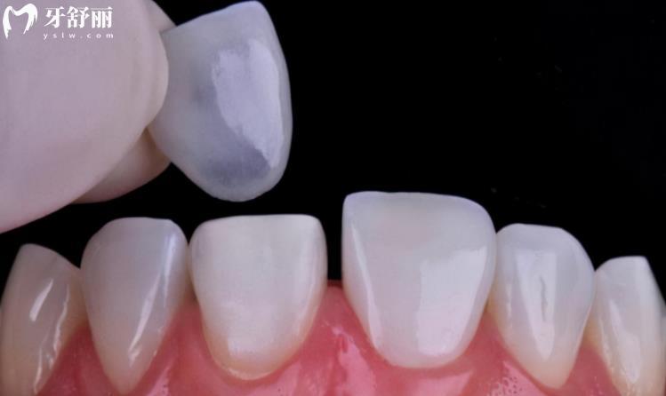 上海做牙齿贴面哪家医院好?审美高磨牙少的医生报价 上海做牙齿贴面哪家医院好?审美高磨牙少的医生报价