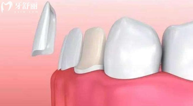 牙贴面的危害有哪些?这些人不建议做牙齿贴面 牙贴面的危害有哪些?这些人不建议做牙齿贴面