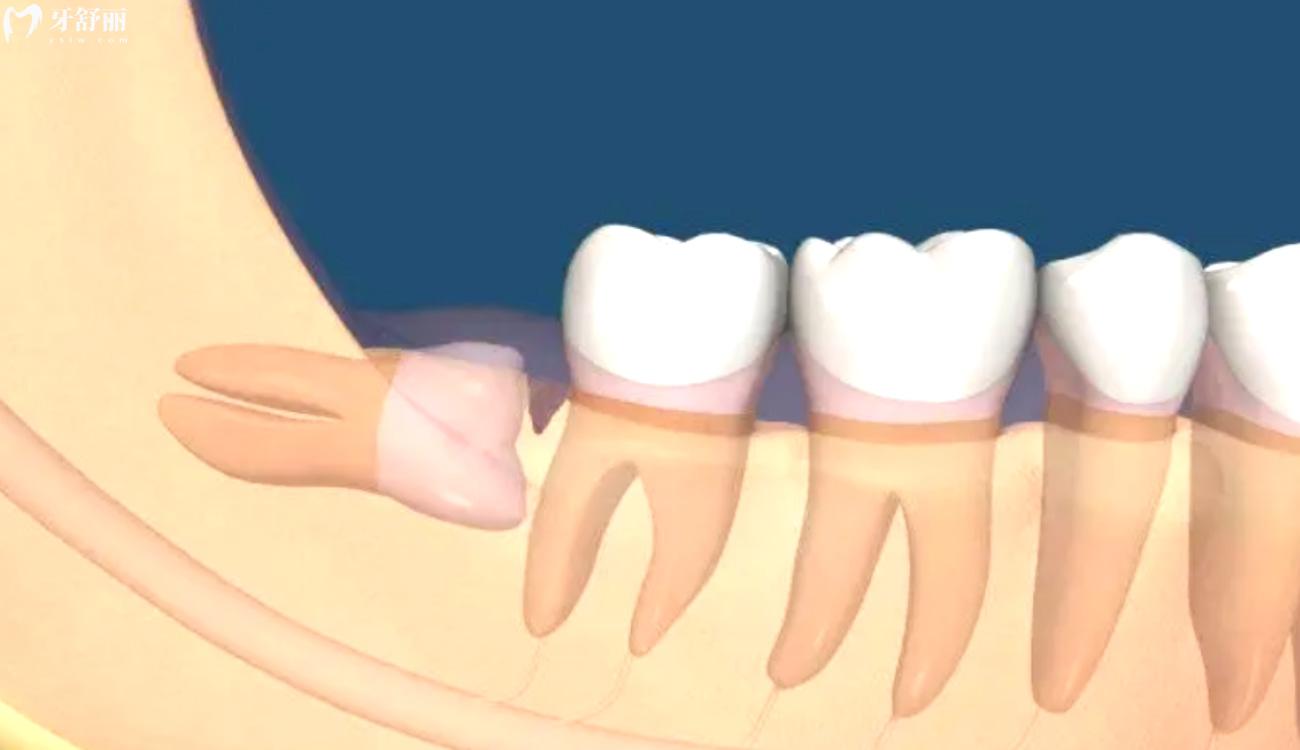 一次拔两颗智齿后悔死了.jpg 一次拔两颗智齿后悔死了.jpg