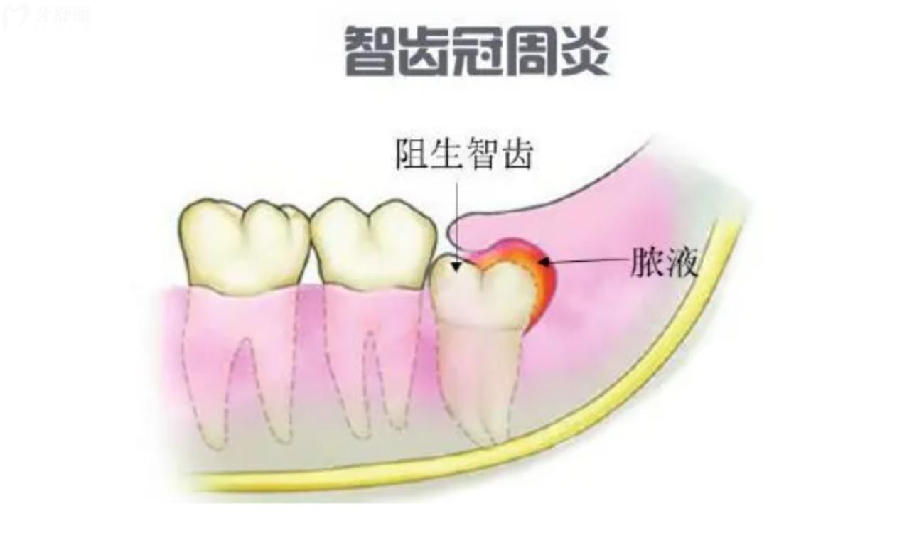 一次拔两颗智齿后悔死了.jpg 一次拔两颗智齿后悔死了.jpg
